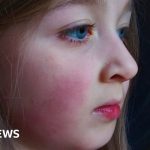 Long Covid: NHS legal action launched by family of girl