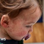 Children who visited hospital traced over measles