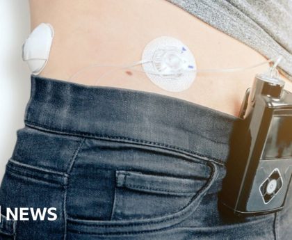 Diabetes patients offered artificial-pancreas tech