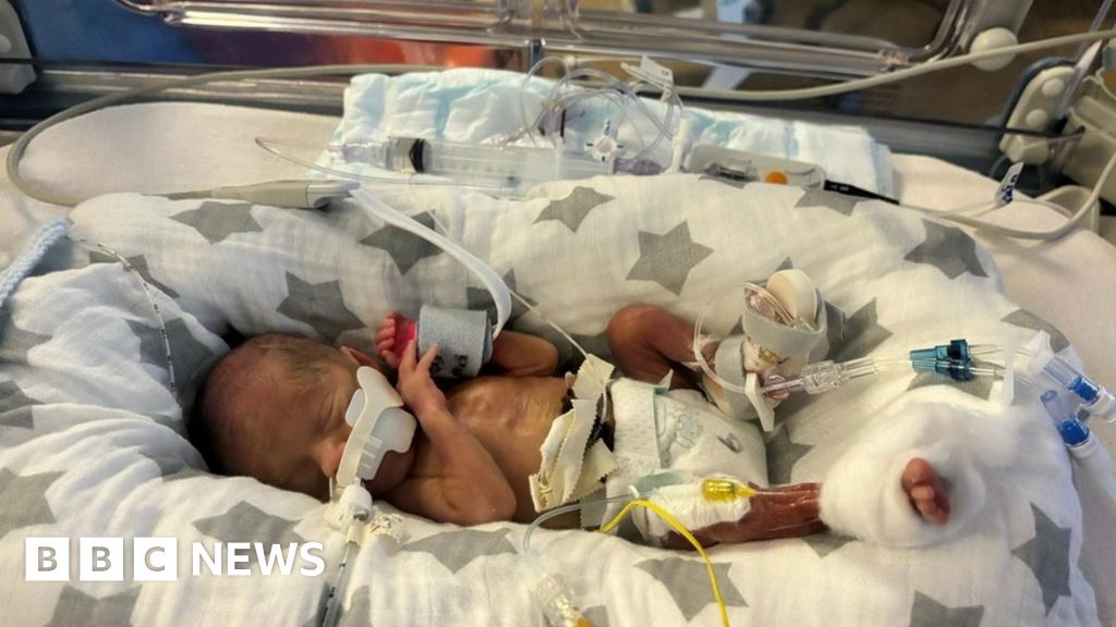 Boxer's premature baby inherits fighting spirit