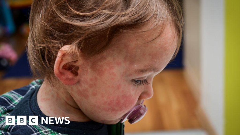 Children who visited hospital traced over measles